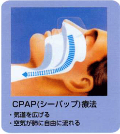 CPAP(シーパップ)